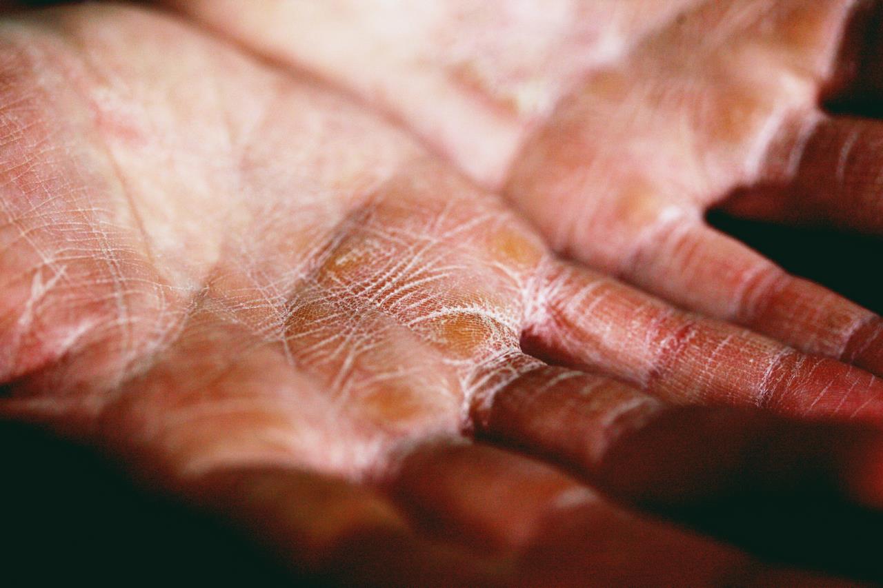 Jakie są różnice między skórą suchą a odwodnioną?