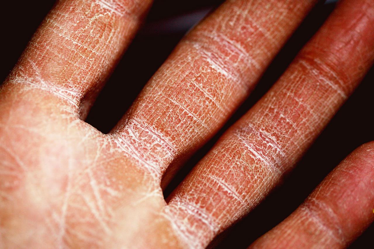 Sucha skóra głowy z łojotokowym zapaleniem skóry – jak leczyć